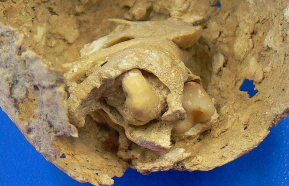 Toothy tumor found lodged in 1,600-year-old Roman corpse