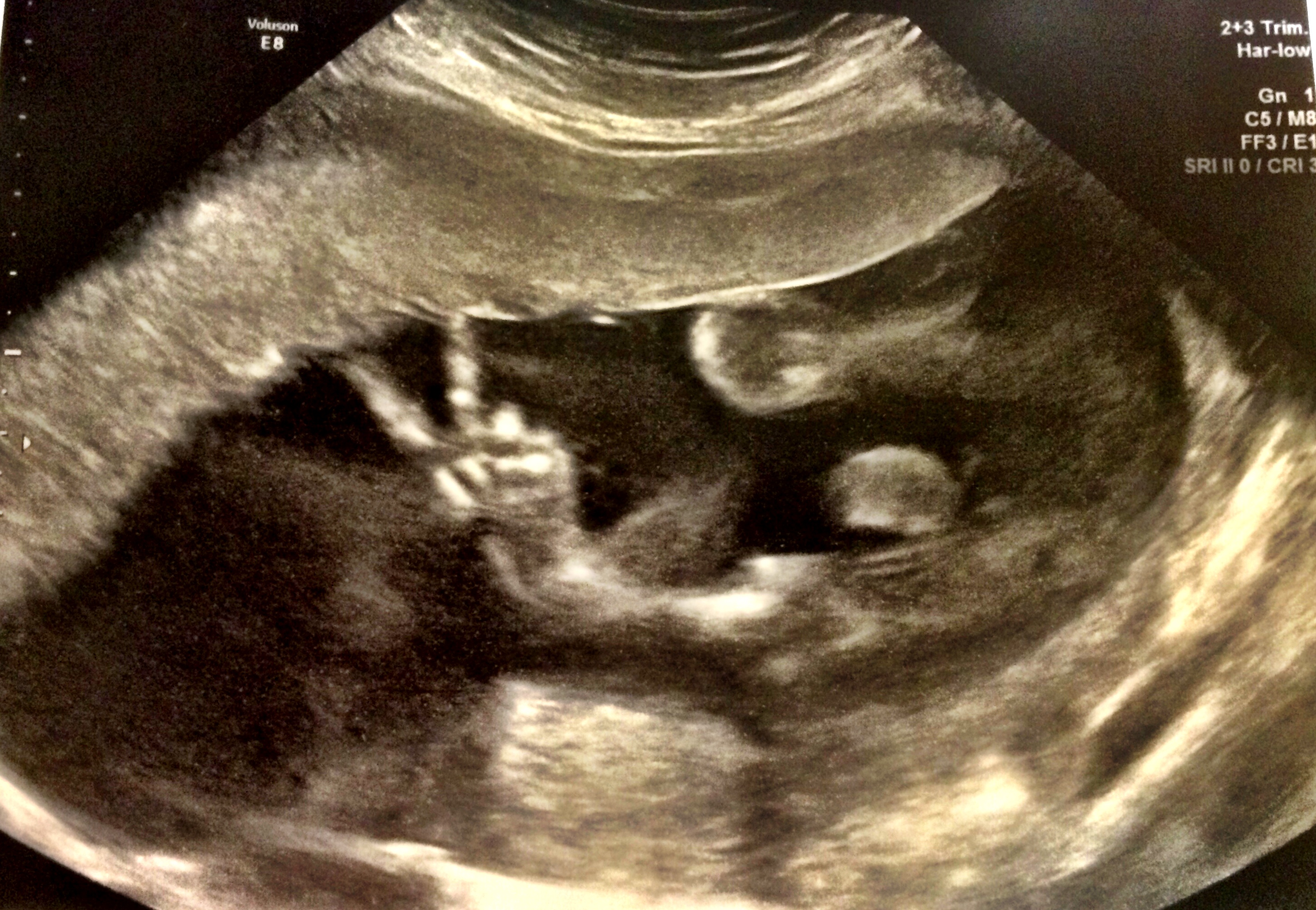 Aaay! 'Fonzie fetus' inspires TODAY viewers to share hilarious ultrasound  photos