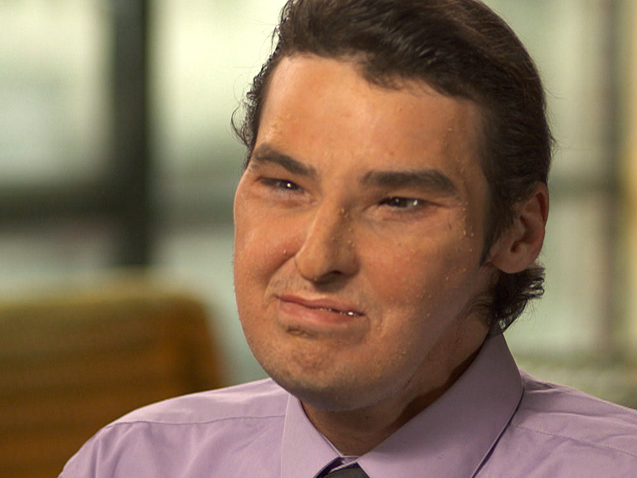 A face in the crowd: A year after most extensive face transplant in history