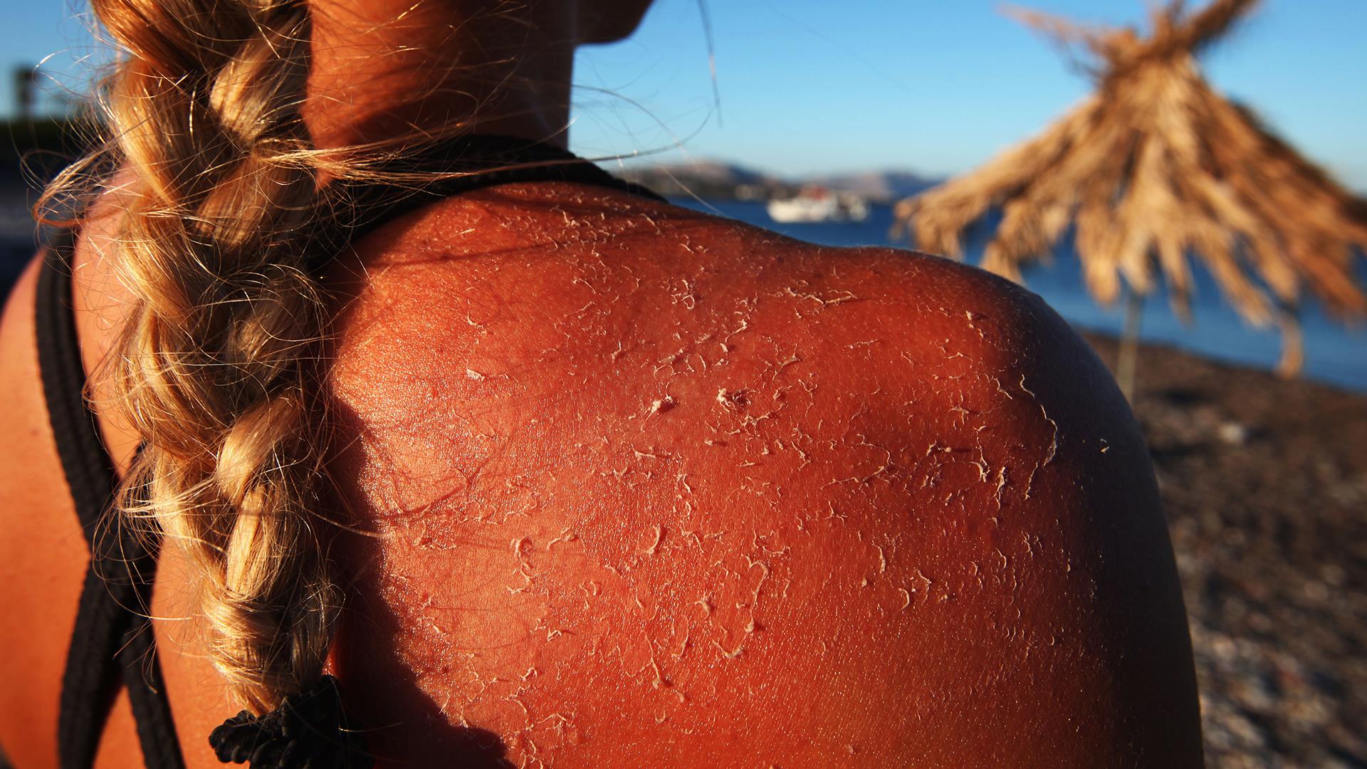 How many sunburns does it take to get skin cancer?