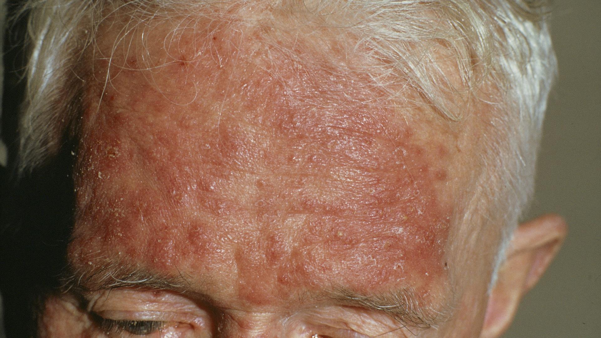 Is rosacea connected to other diseases?