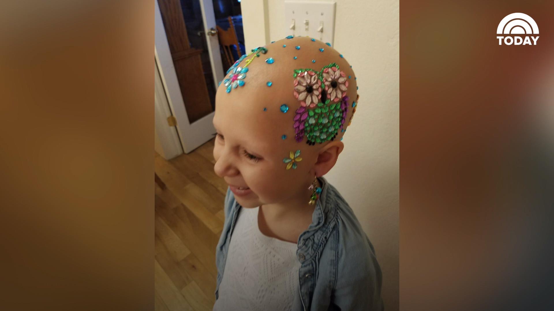 Girl with alopecia decorates her head for crazy hair day