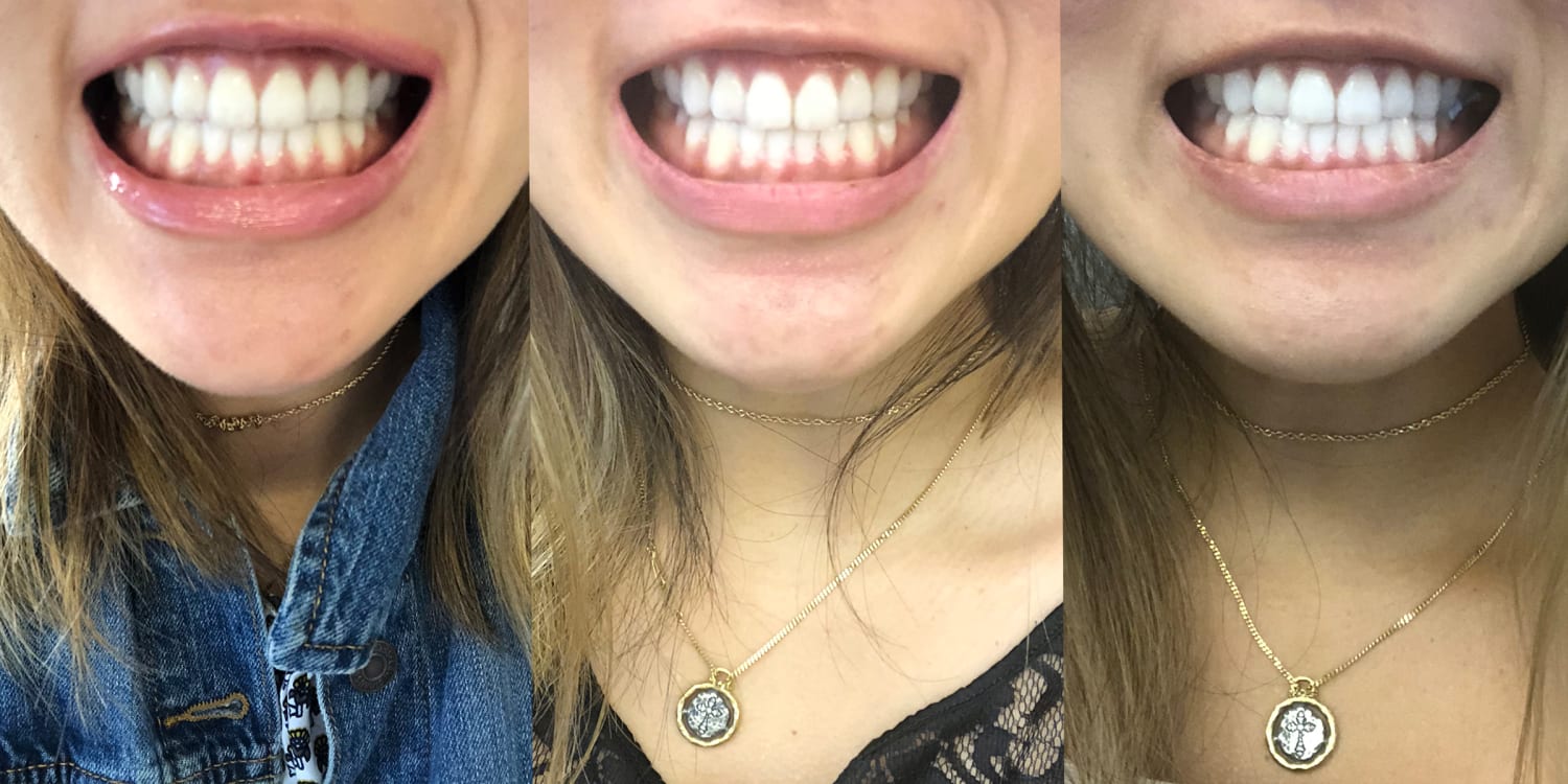 Coffee Stained Teeth Reddit Image of Coffee and Tea