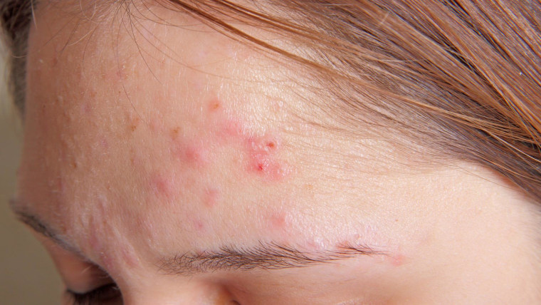 can acne look like bug bites