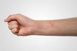 eczema skin on hand