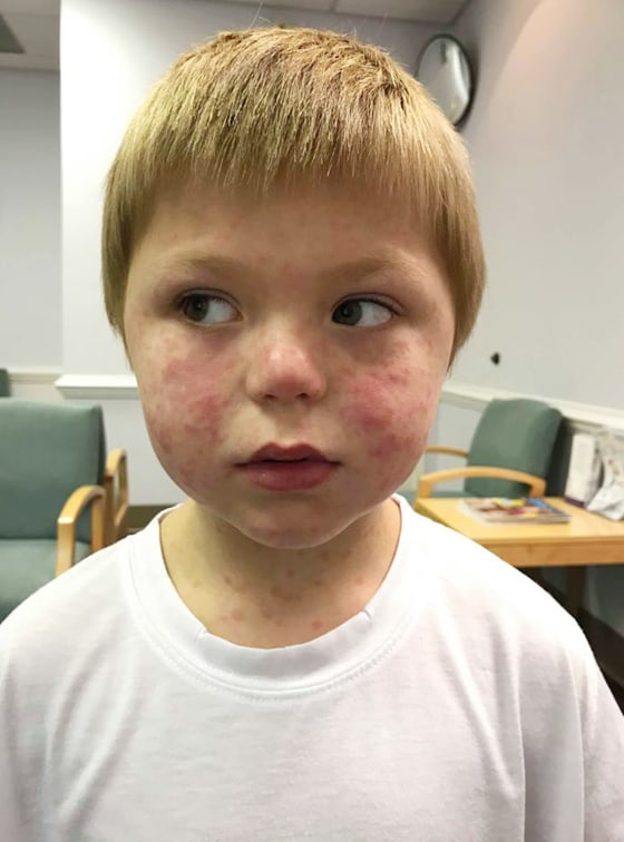 Rocky Mountain Spotted Fever rash