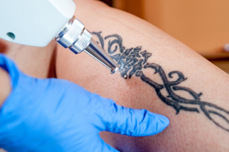 How To Remove Tattoo Ink Naturally Wiki Tattoo
