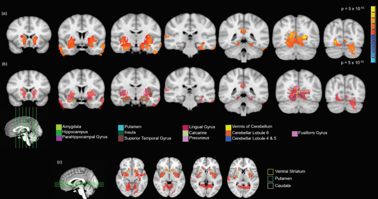Image: Various figures show grey matter volume differences after cannabis use in adolescents.