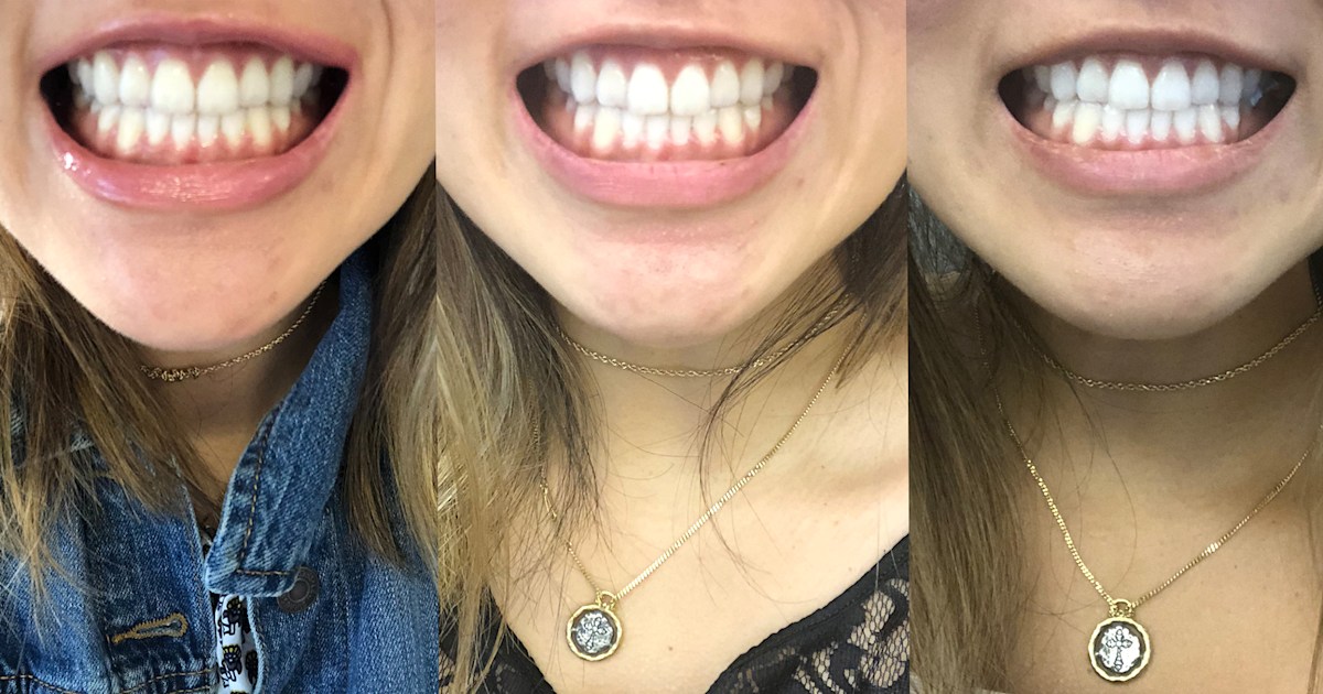 Do LED teeth whitening kits work? I tried teeth whitening