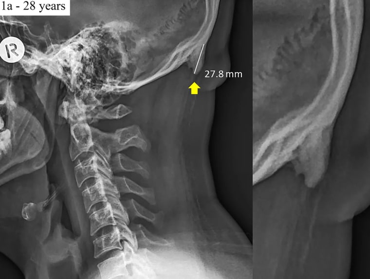 Image: Example of a radiograph of a male 28-year-old presenting with large enthesophytes emanating from the occipital squama.