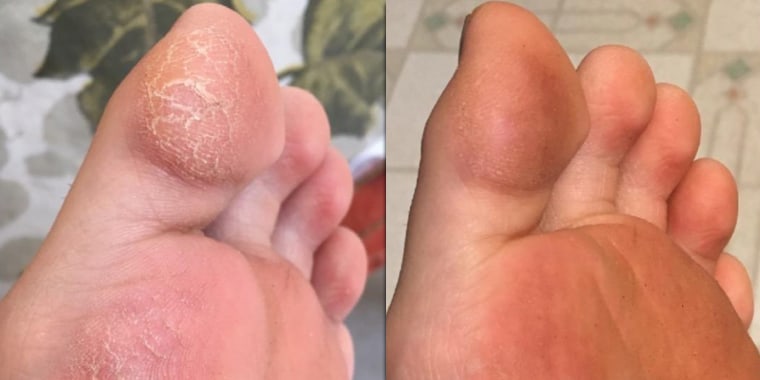 foot cream for dry, cracked skin