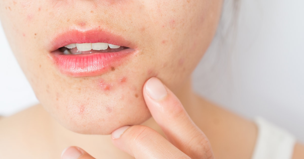 How to get rid of blackheads, according to dermatologists