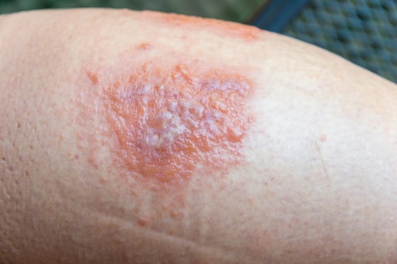 When To Worry About A Rash In Adults 7 Skin Warning Signs